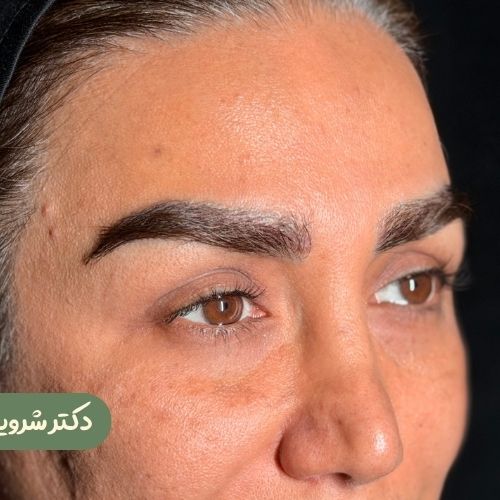 قبل از لیفت شقیقه