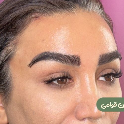بعد از لیفت شقیقه