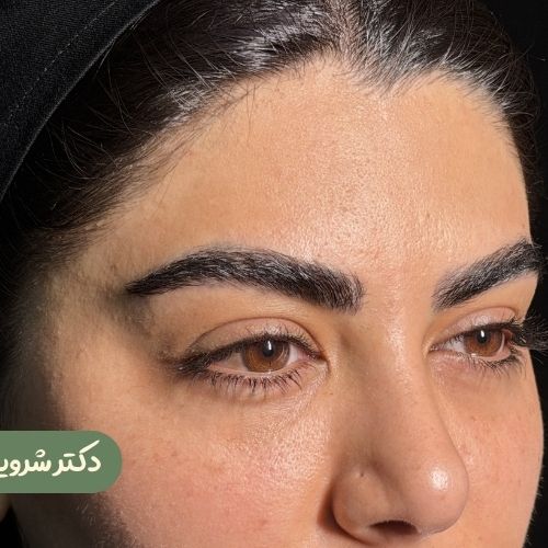 قبل از لیفت شقیقه