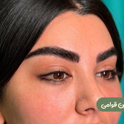 بعد از لیفت شقیقه