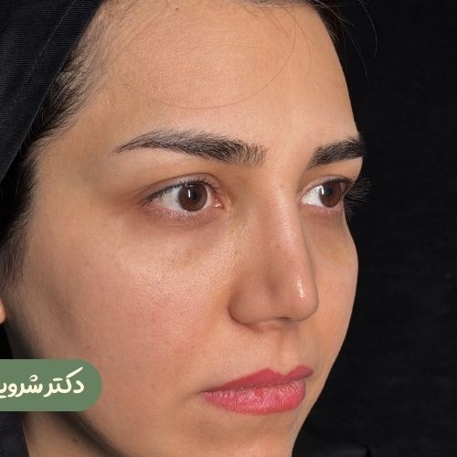 قبل از لیفت شقیقه + رینوپلاستی ترمیمی