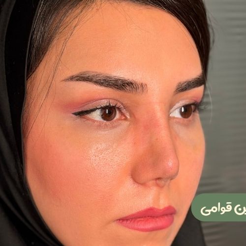 بعد از لیفت شقیقه + رینوپلاستی ترمیمی