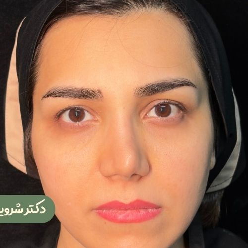 قبل از لیفت شقیقه + رینوپلاستی ترمیمی