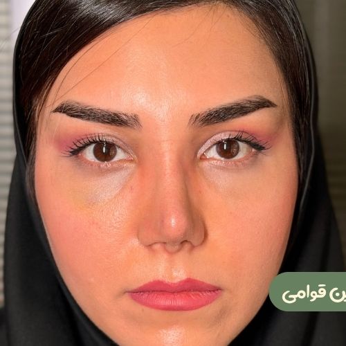 بعد از لیفت شقیقه + رینوپلاستی ترمیمی