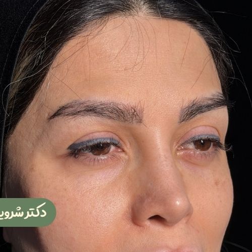 قبل از لیفت شقیقه + دایرکت ابرو + بلفاروپلاستی