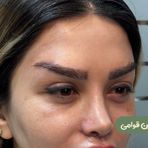 بعد از لیفت شقیقه + دایرکت ابرو + بلفاروپلاستی