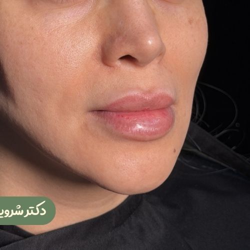 قبل از سانترال لب