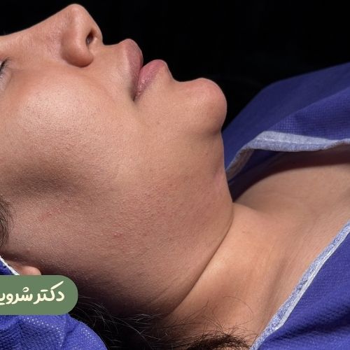 قبل از ساکشن غبغب