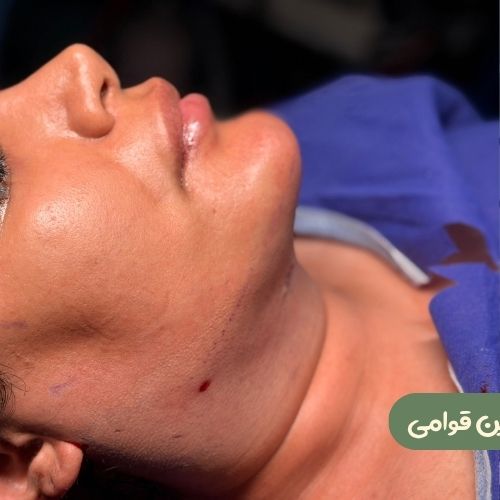 بعد از ساکشن غبغب
