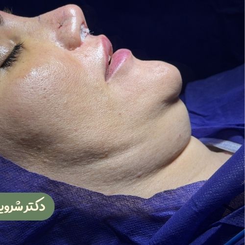 قبل از ساکشن غبغب