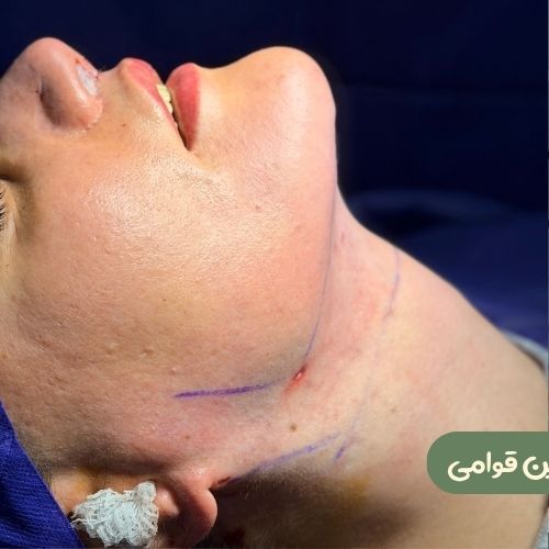 بعد از ساکشن غبغب