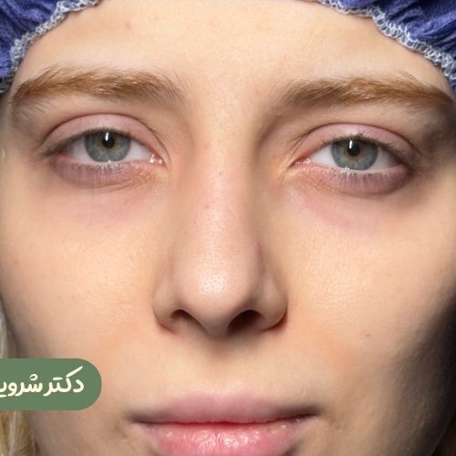 قبل از رینوپلاستی