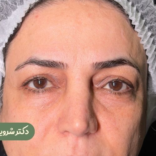قبل از دایرکت ابرو + بلفاروپلاستی