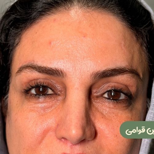 بعد از دایرکت ابرو + بلفاروپلاستی