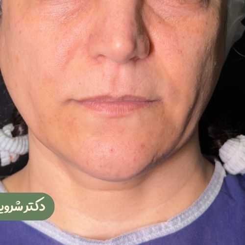 قبل از سانترال لب