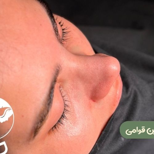 بعد از رینوپلاستی