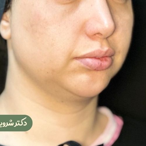 قبل از بوکال فت + ساکشن غبغب