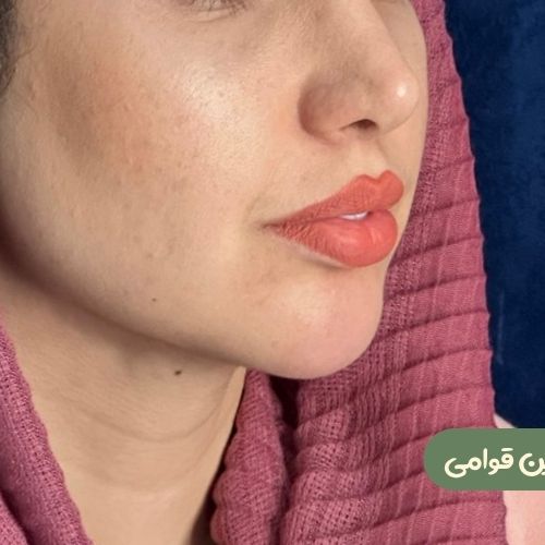 بعد از بوکال فت + ساکشن غبغب