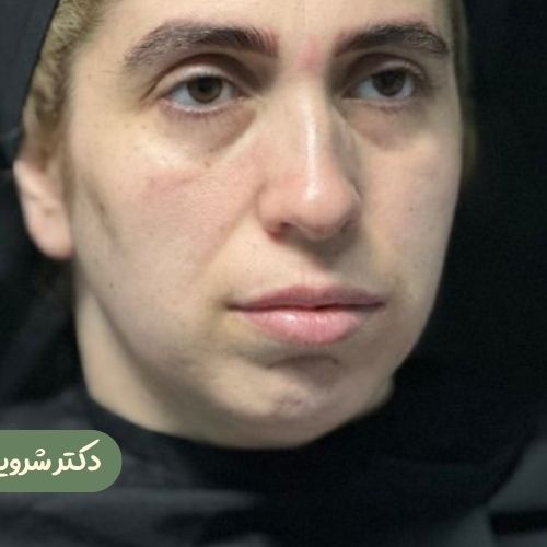 قبل از رینوپلاستی + ژنیوپلاستی