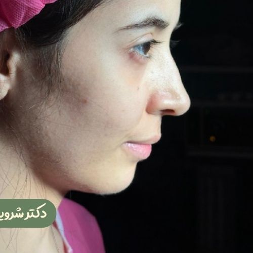 قبل از رینوپلاستی + ژنیوپلاستی