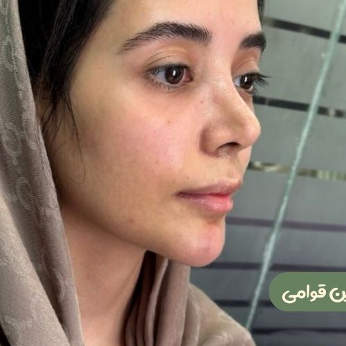 بعد از رینوپلاستی + ژنیوپلاستی