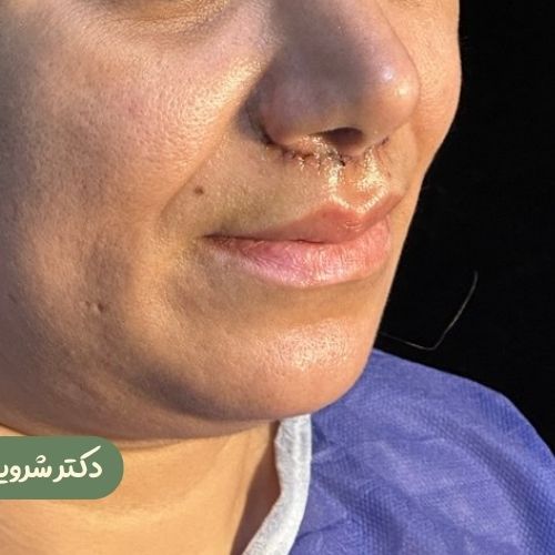 قبل از سانترال لب