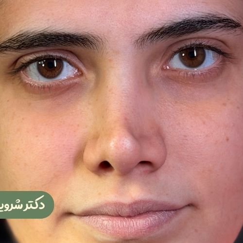 قبل از رینوپلاستی ترمیمی
