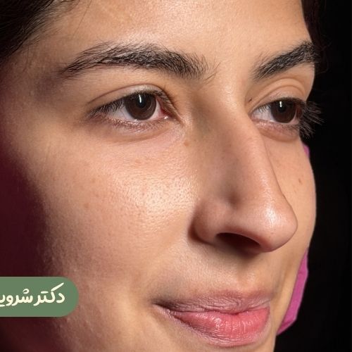 قبل از رینوپلاستی