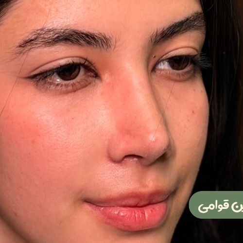 بعد از رینوپلاستی