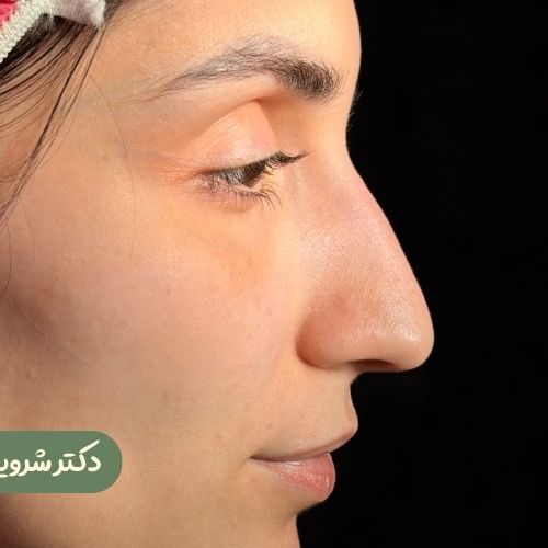 قبل از رینوپلاستی