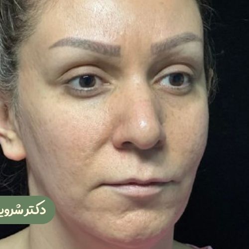 قبل از رینوپلاستی