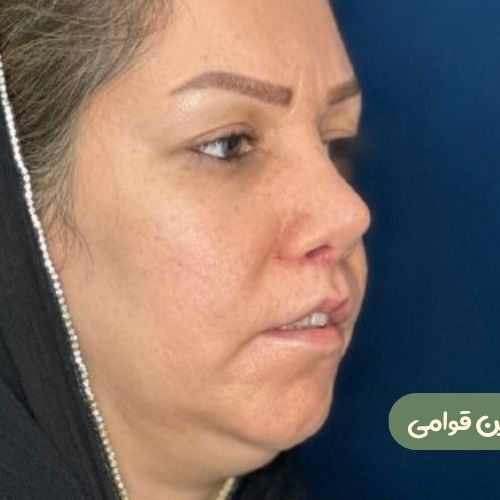بعد از رینوپلاستی