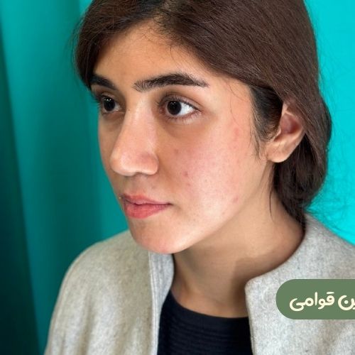 بعد از رینوپلاستی + ژنیوپلاستی