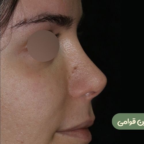 بعد از رینوپلاستی