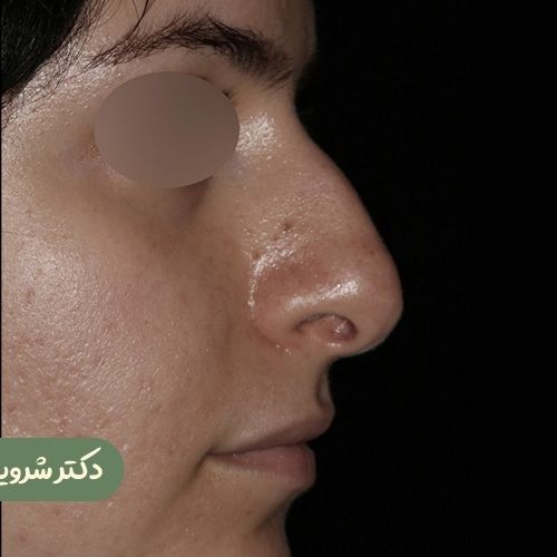 قبل از رینوپلاستی