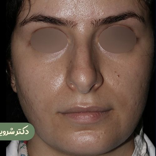 قبل از رینوپلاستی