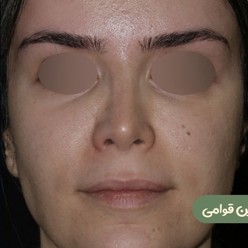 بعد از رینوپلاستی