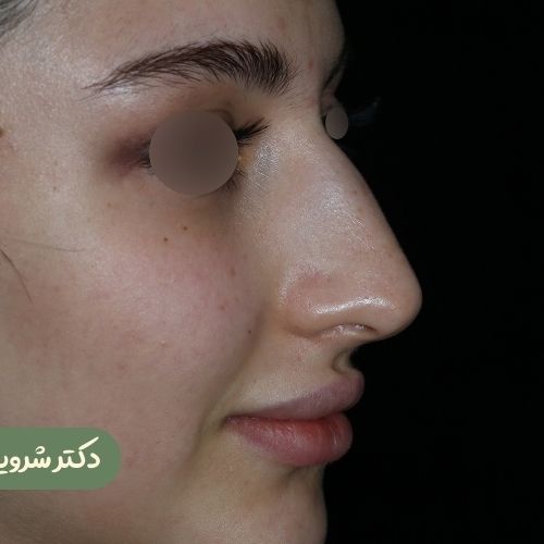قبل از رینوپلاستی