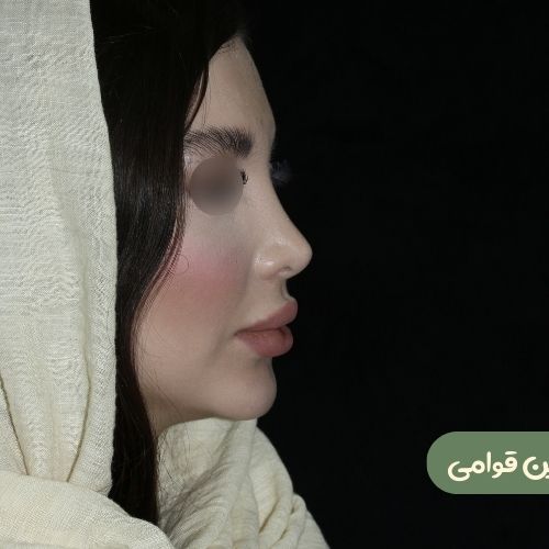 بعد از رینوپلاستی