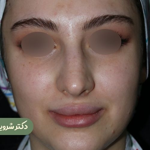 قبل از رینوپلاستی