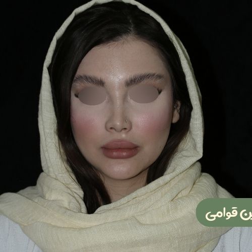 بعد از رینوپلاستی