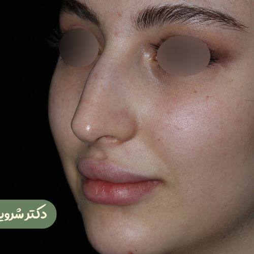 قبل از رینوپلاستی