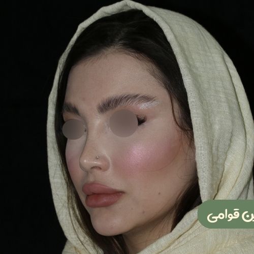 بعد از رینوپلاستی