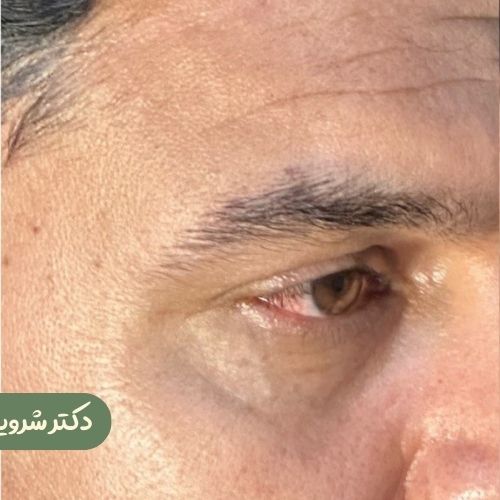 قبل از لیفت شقیقه