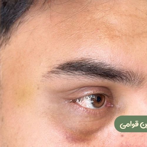 بعد از لیفت شقیقه