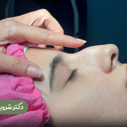قبل از رینوپلاستی