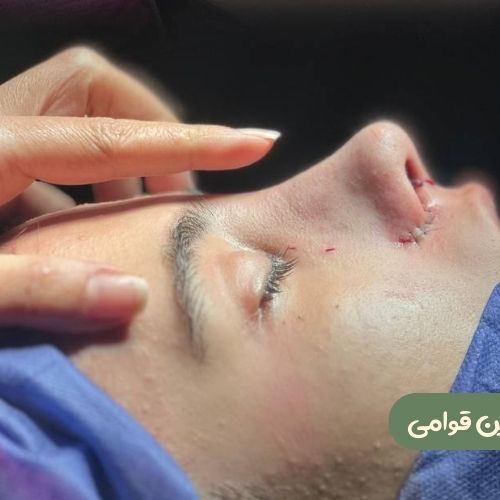 بعد از رینوپلاستی