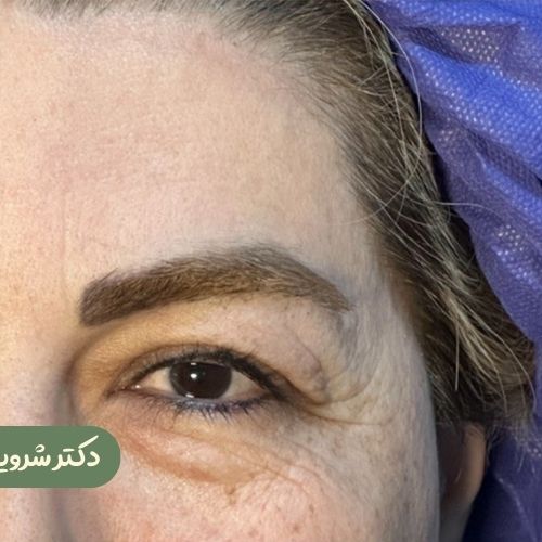 قبل از بلفاروپلاستی + لیفت شقیقه