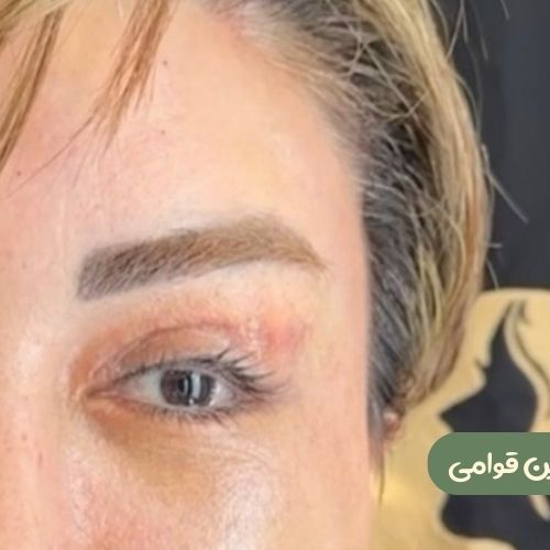 بعد از بلفاروپلاستی + لیفت شقیقه