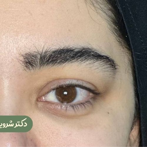 قبل از لیفت شقیقه